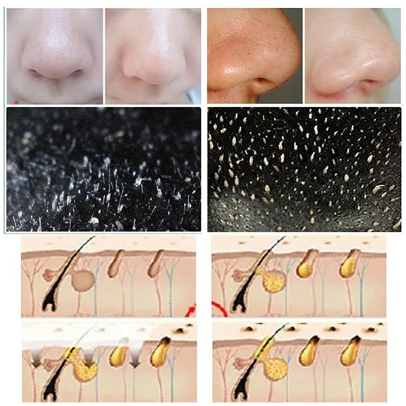 Bandes de points noirs pour le - Cleanser Face avis et prix